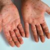 Foto mostra duas mãos com pintas vermelhas de sarampo.