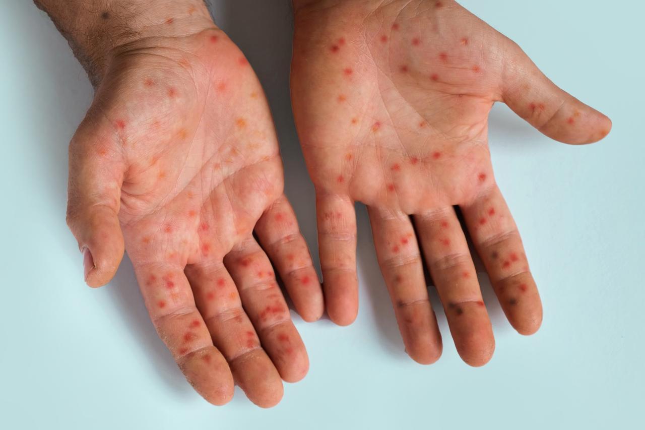 Foto mostra duas mãos com pintas vermelhas de sarampo.