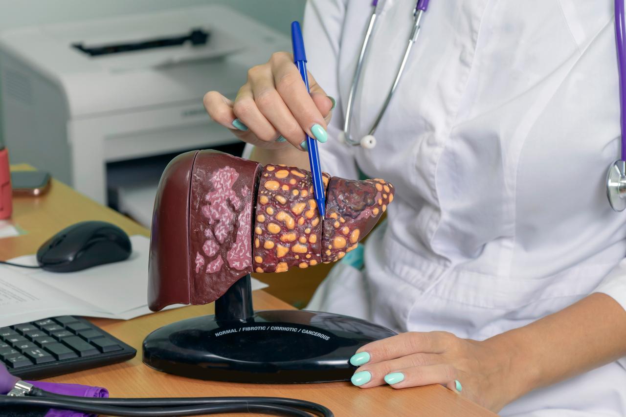 A esteatose hepática pode se desenvolver por anos sem causar sintomas, tornando a prevenção ainda mais importante