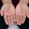 O fenômeno de Raynaud provoca alterações temporárias na circulação das extremidades, principalmente durante o frio