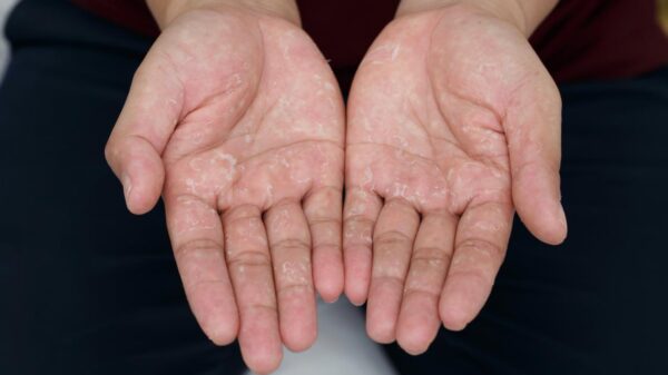 O fenômeno de Raynaud provoca alterações temporárias na circulação das extremidades, principalmente durante o frio