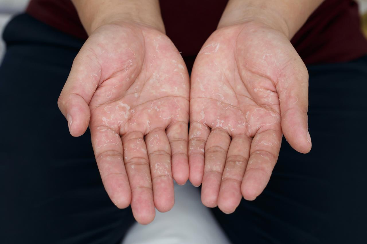 O fenômeno de Raynaud provoca alterações temporárias na circulação das extremidades, principalmente durante o frio