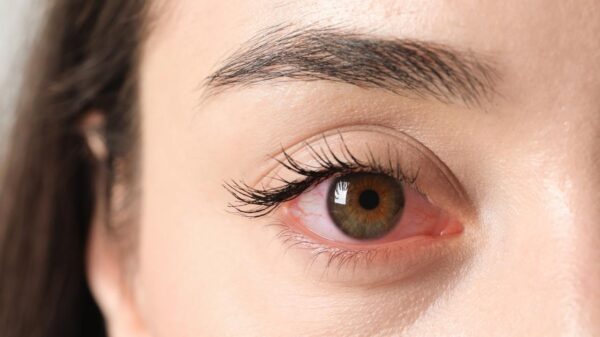 Olhos vermelhos, lacrimejamento e secreção estão entre os principais sintomas da conjuntivite
