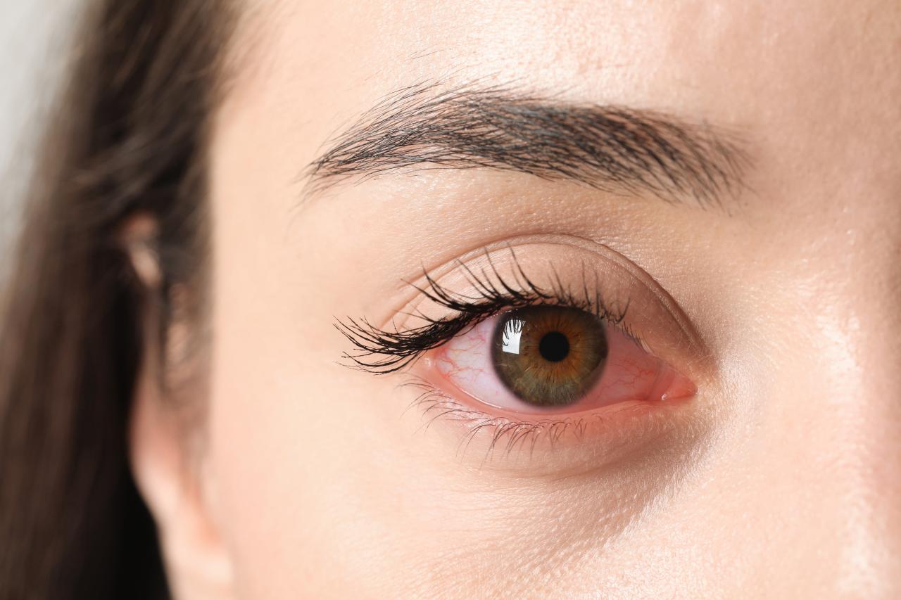 Olhos vermelhos, lacrimejamento e secreção estão entre os principais sintomas da conjuntivite
