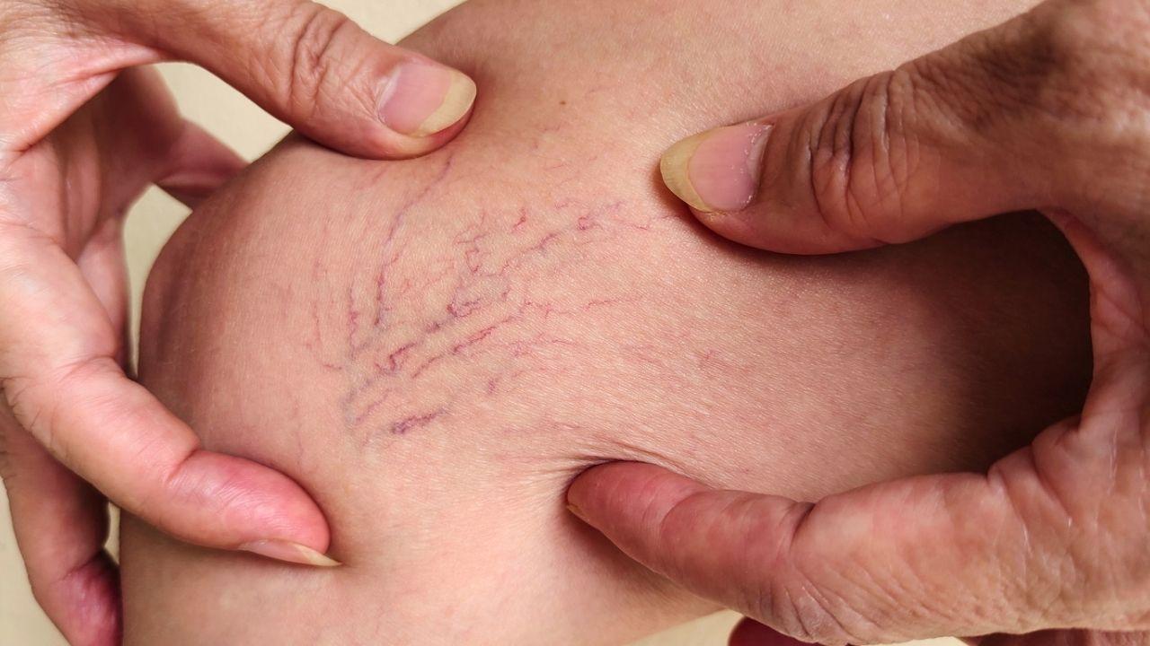 Saúde vascular após os 40: sinais, doenças e como proteger suas pernas