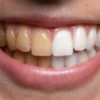 Consumo frequente de energéticos pode afetar a saúde dos dentes