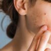 Mulher com marcas de acne vermelhas no rosto.