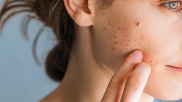 Mulher com marcas de acne vermelhas no rosto.