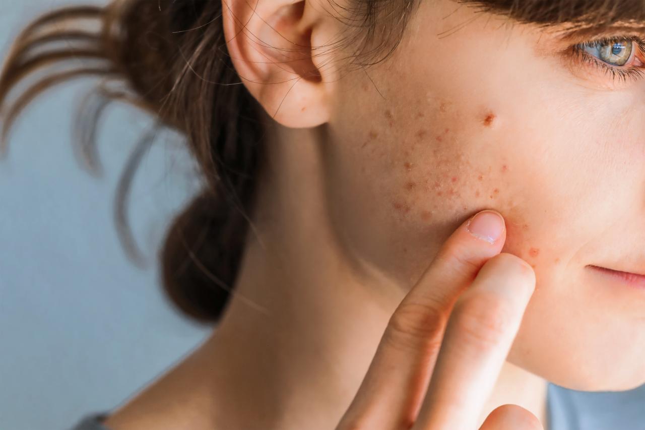 Mulher com marcas de acne vermelhas no rosto.