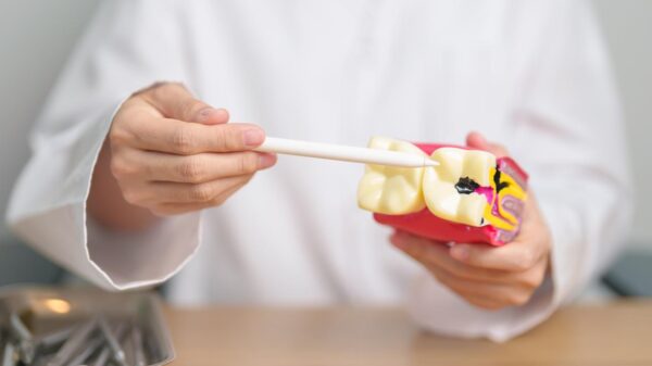 Profissional mostrando uma representação de dente com cárie, sentado num consultório.