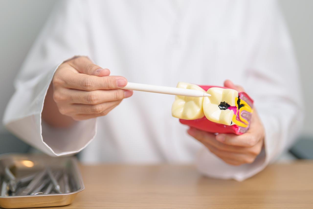 Profissional mostrando uma representação de dente com cárie, sentado num consultório.